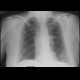 Lung metastases: X-ray - Plain radiograph